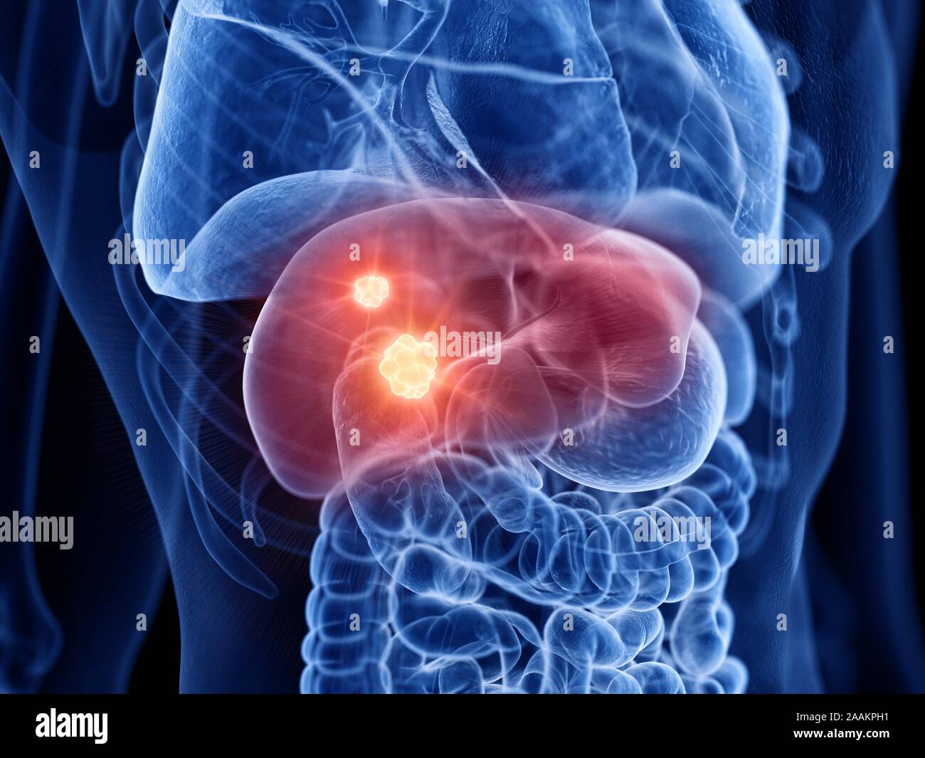 Leberkrebs, Computer Bild. Stockfoto