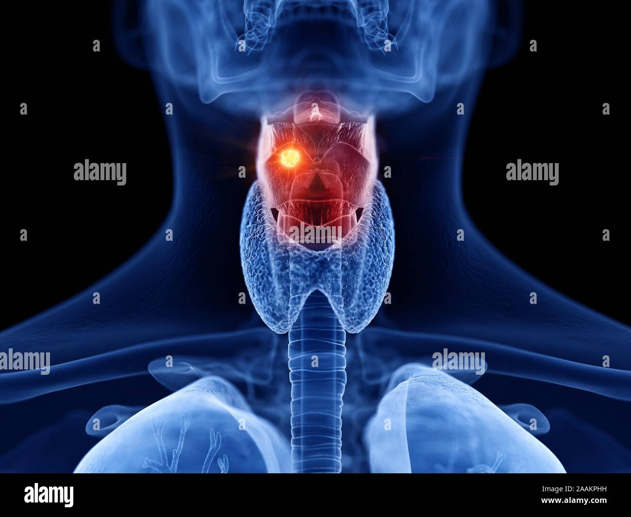 Kehlkopf Krebs, computer Abbildung. Stockfoto