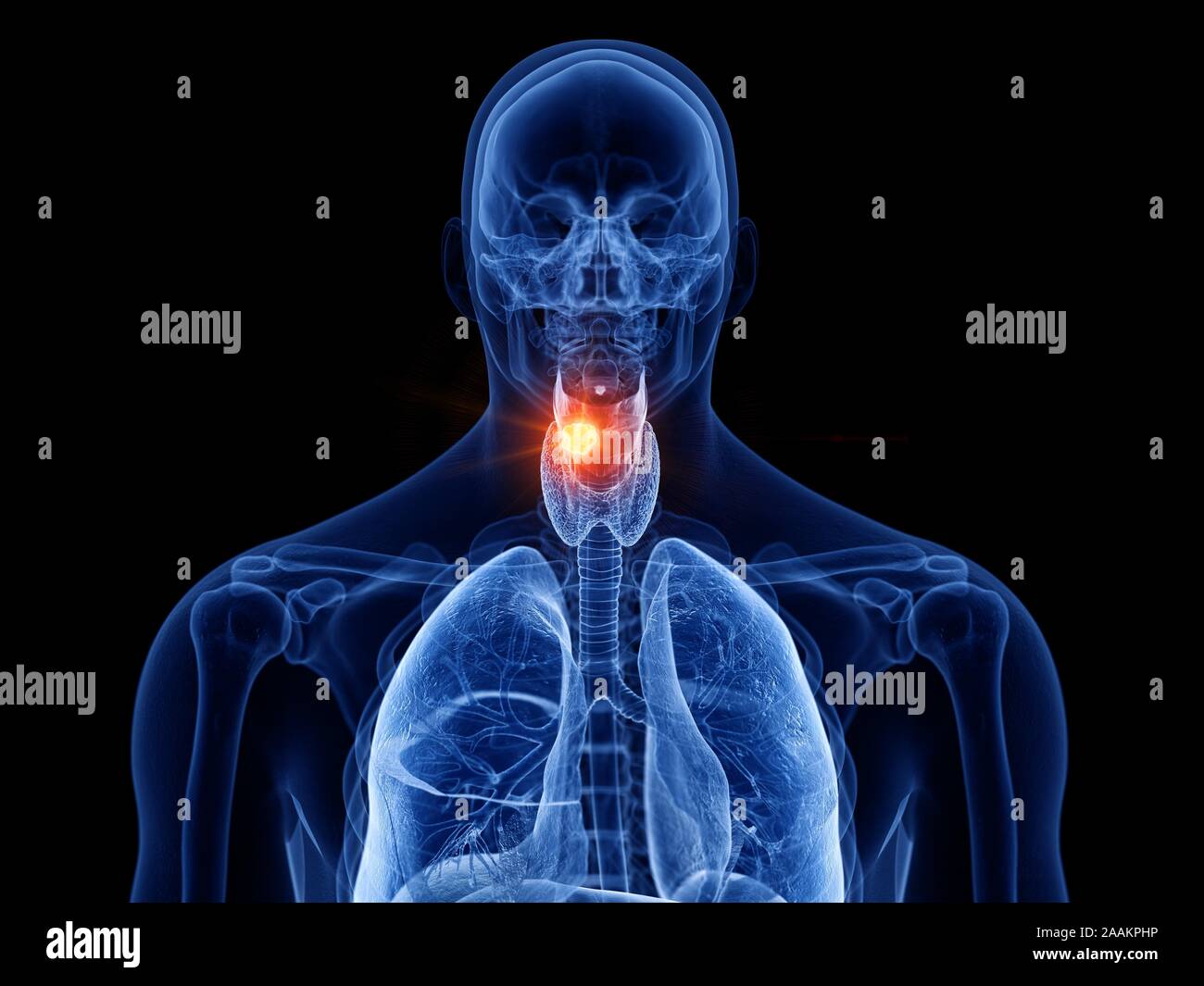 Kehlkopf Krebs, computer Abbildung. Stockfoto