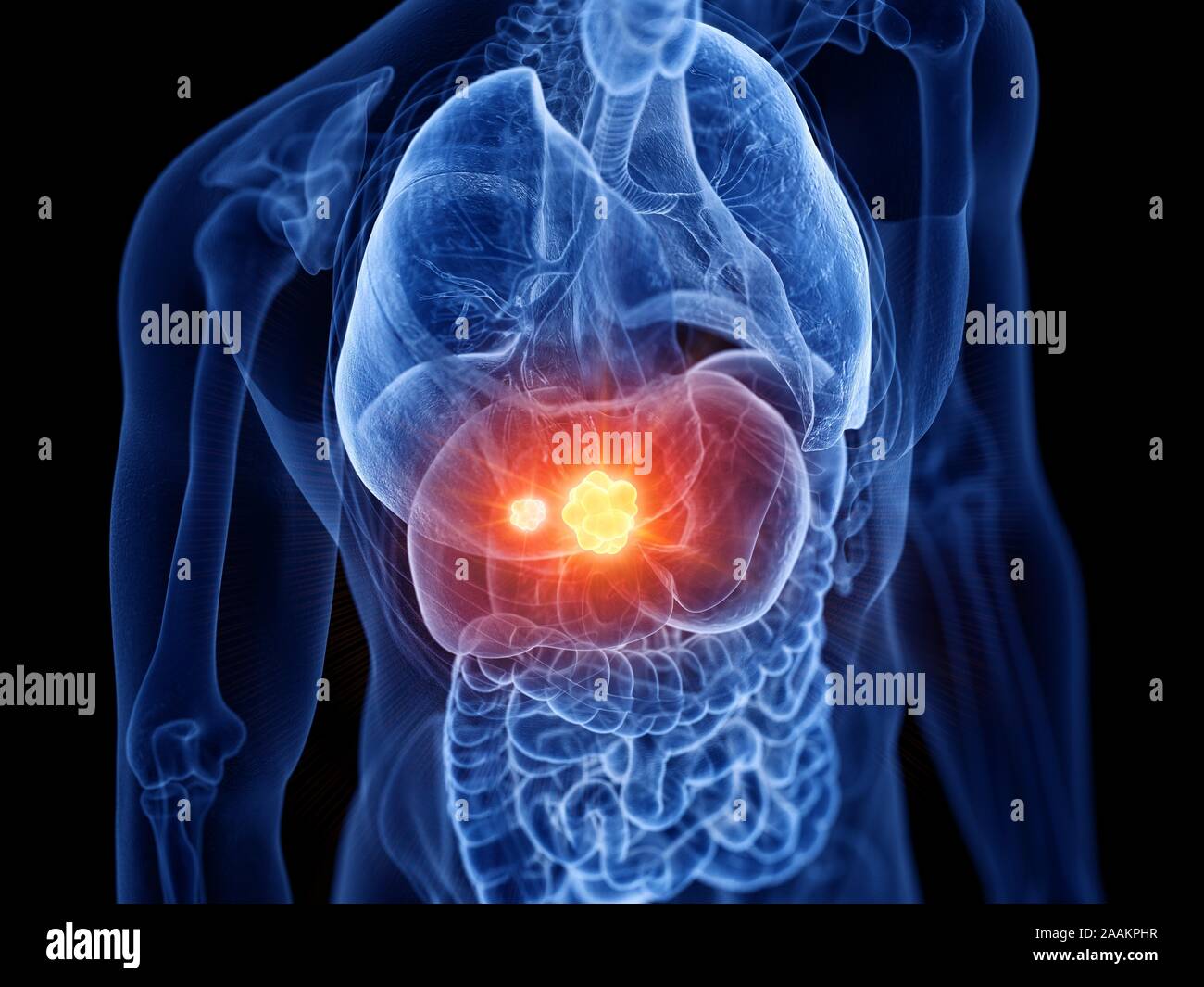 Leberkrebs, Computer Bild. Stockfoto