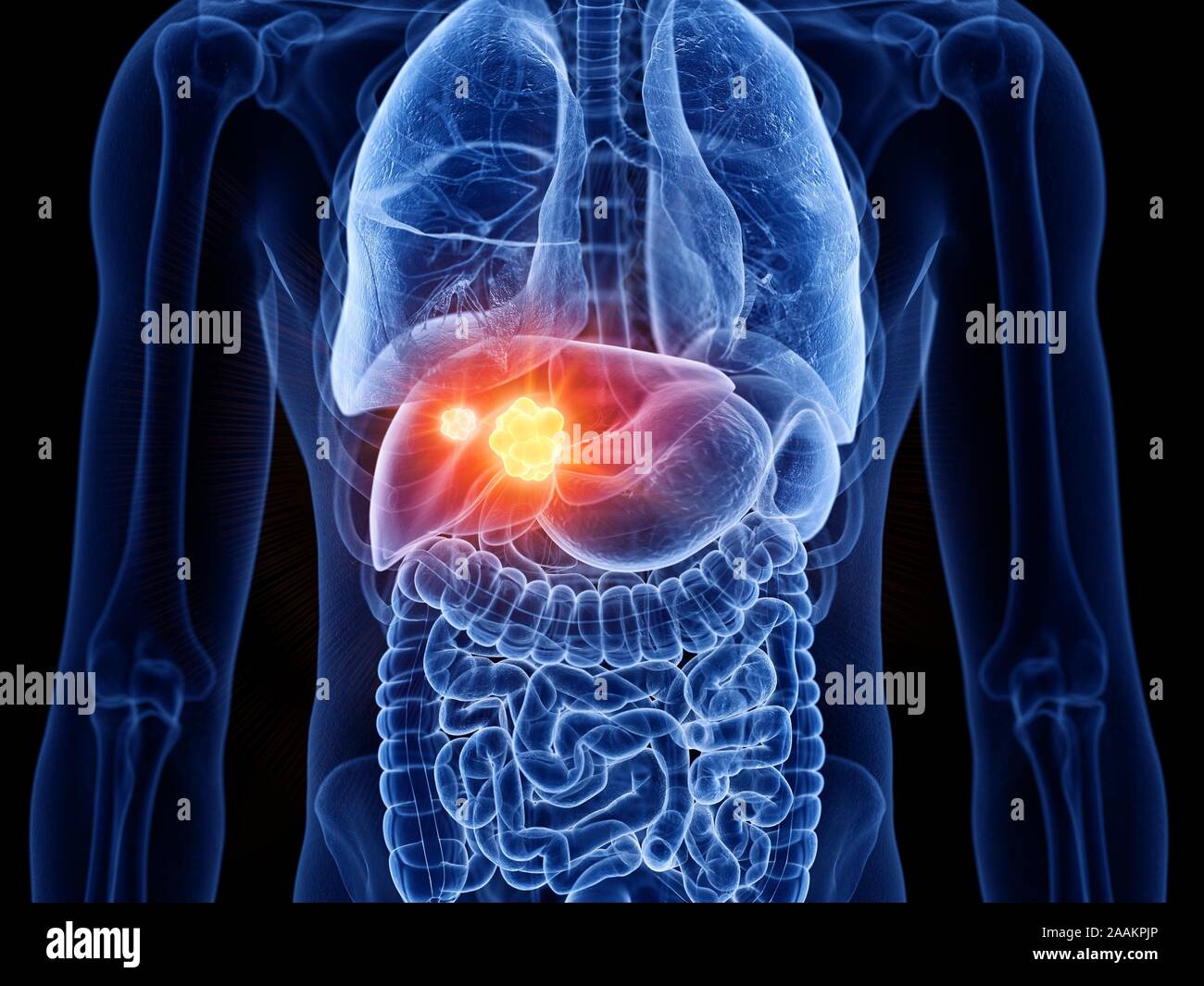 Leberkrebs, Computer Bild. Stockfoto