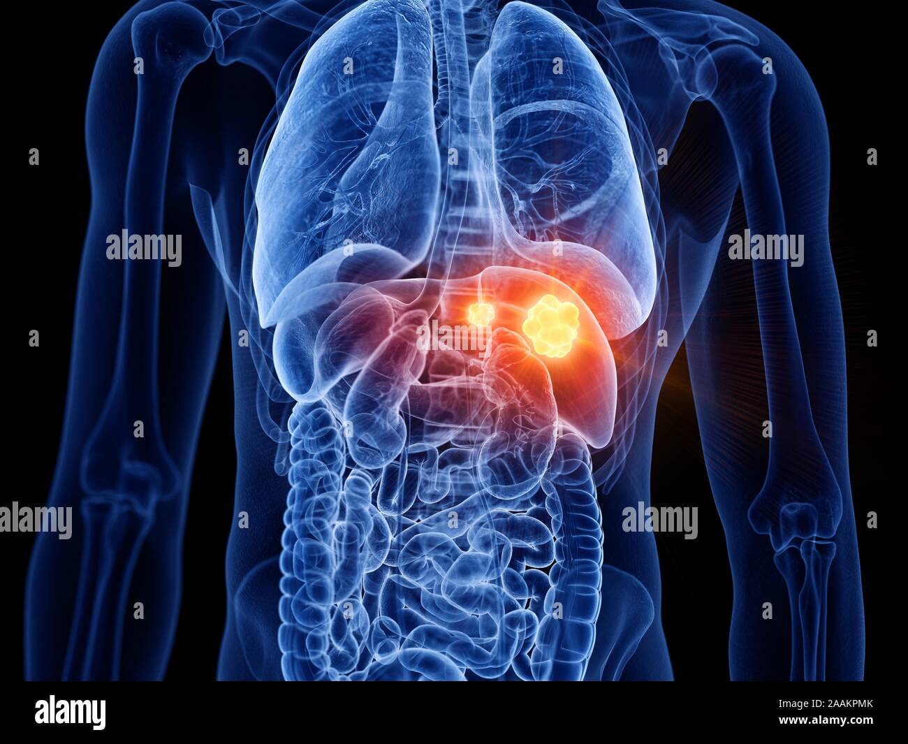 Leberkrebs, Computer Bild. Stockfoto