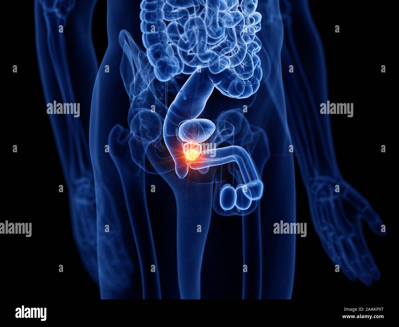 Prostatakrebs, computer Abbildung. Stockfoto