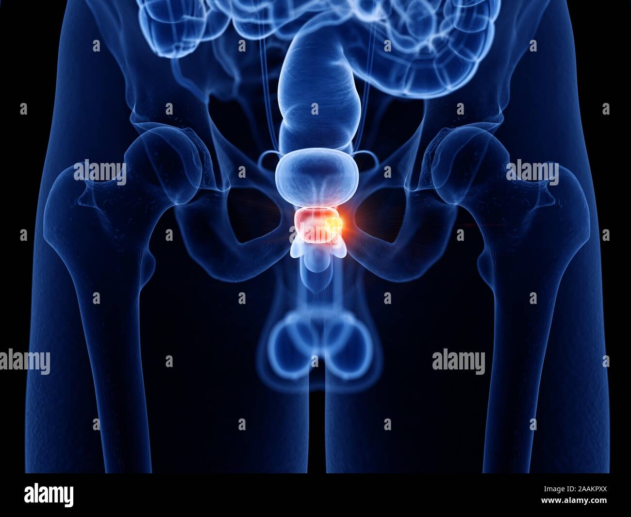 Prostatakrebs, computer Abbildung. Stockfoto