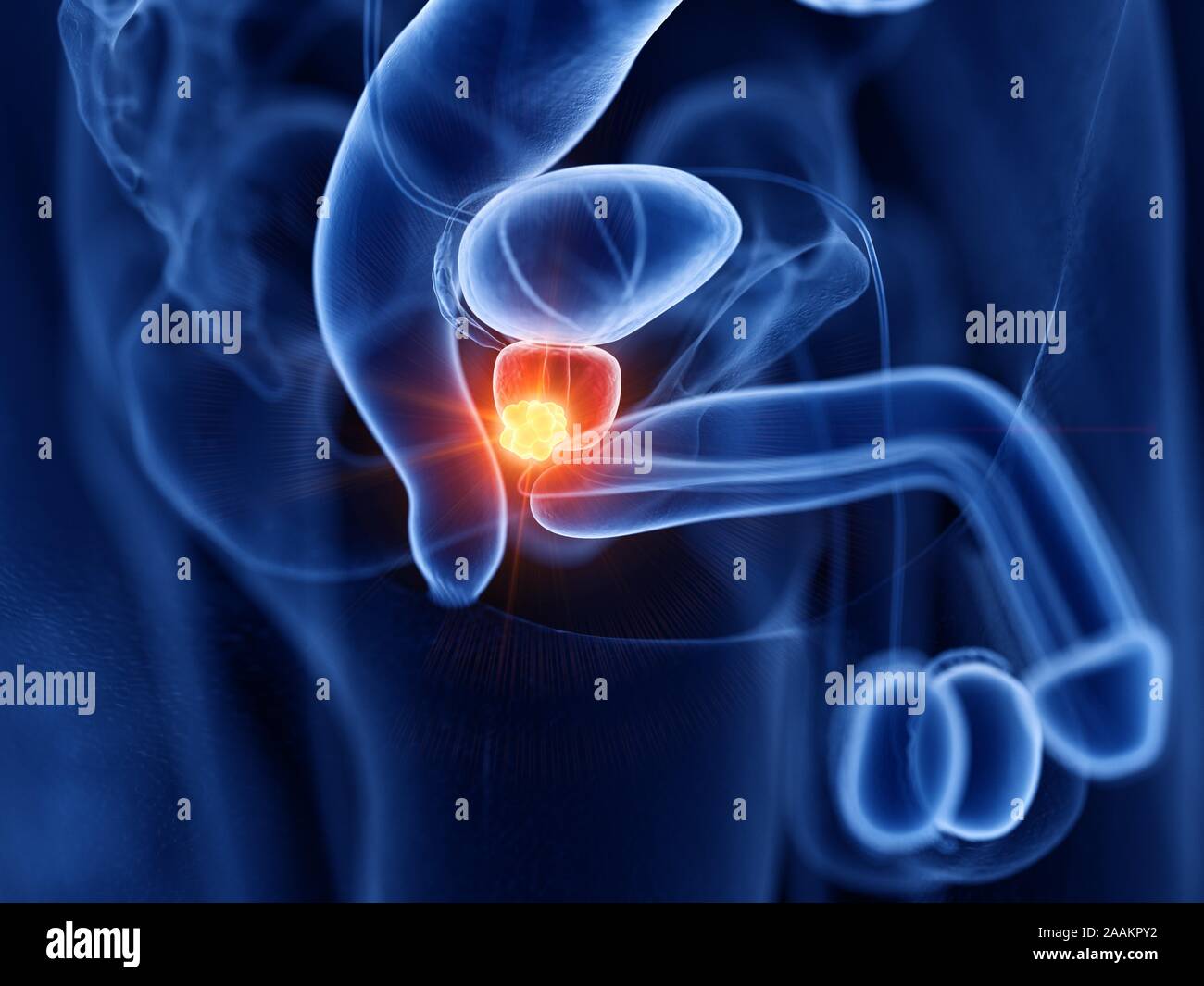 Prostatakrebs, computer Abbildung. Stockfoto