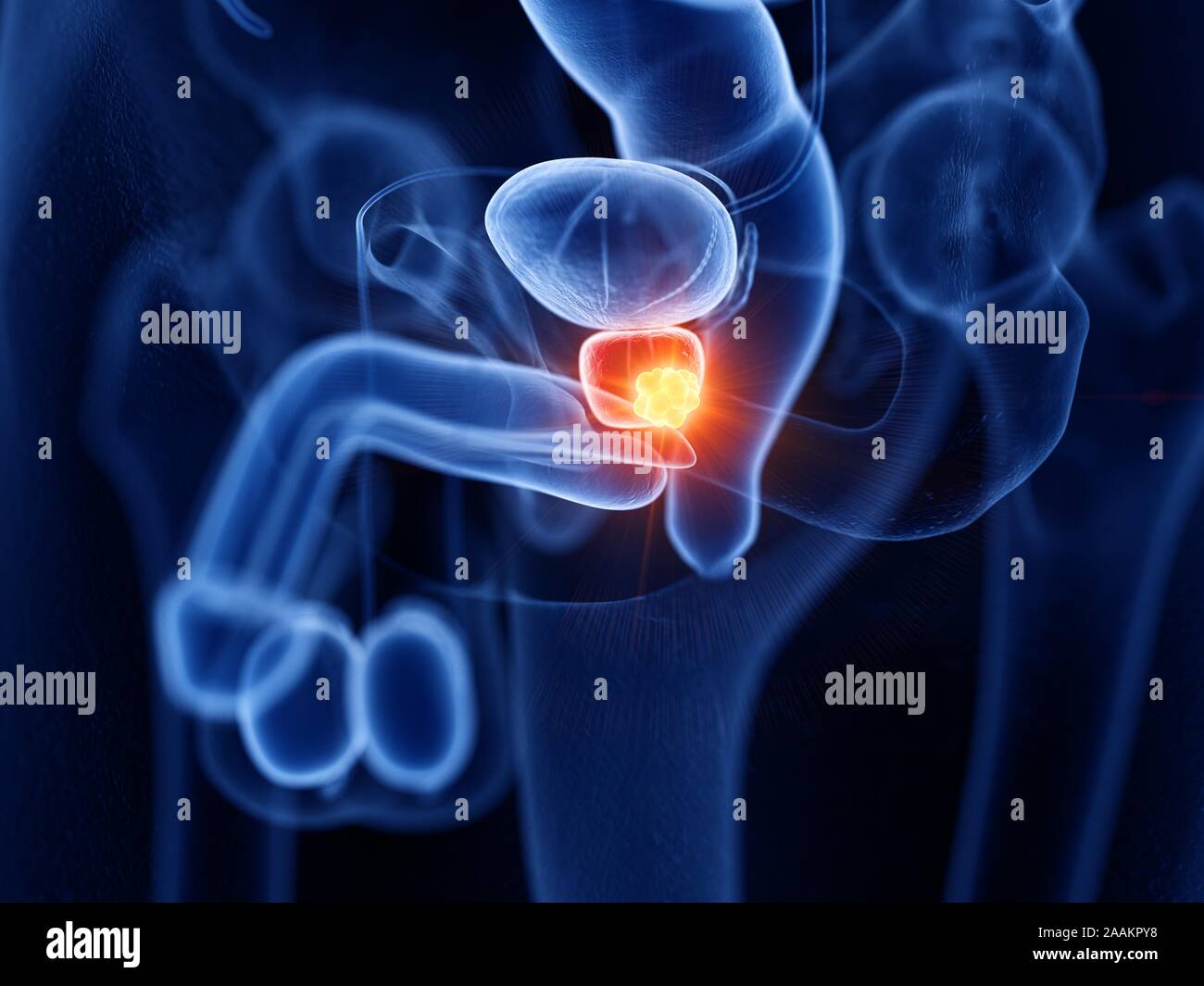 Prostatakrebs, computer Abbildung. Stockfoto