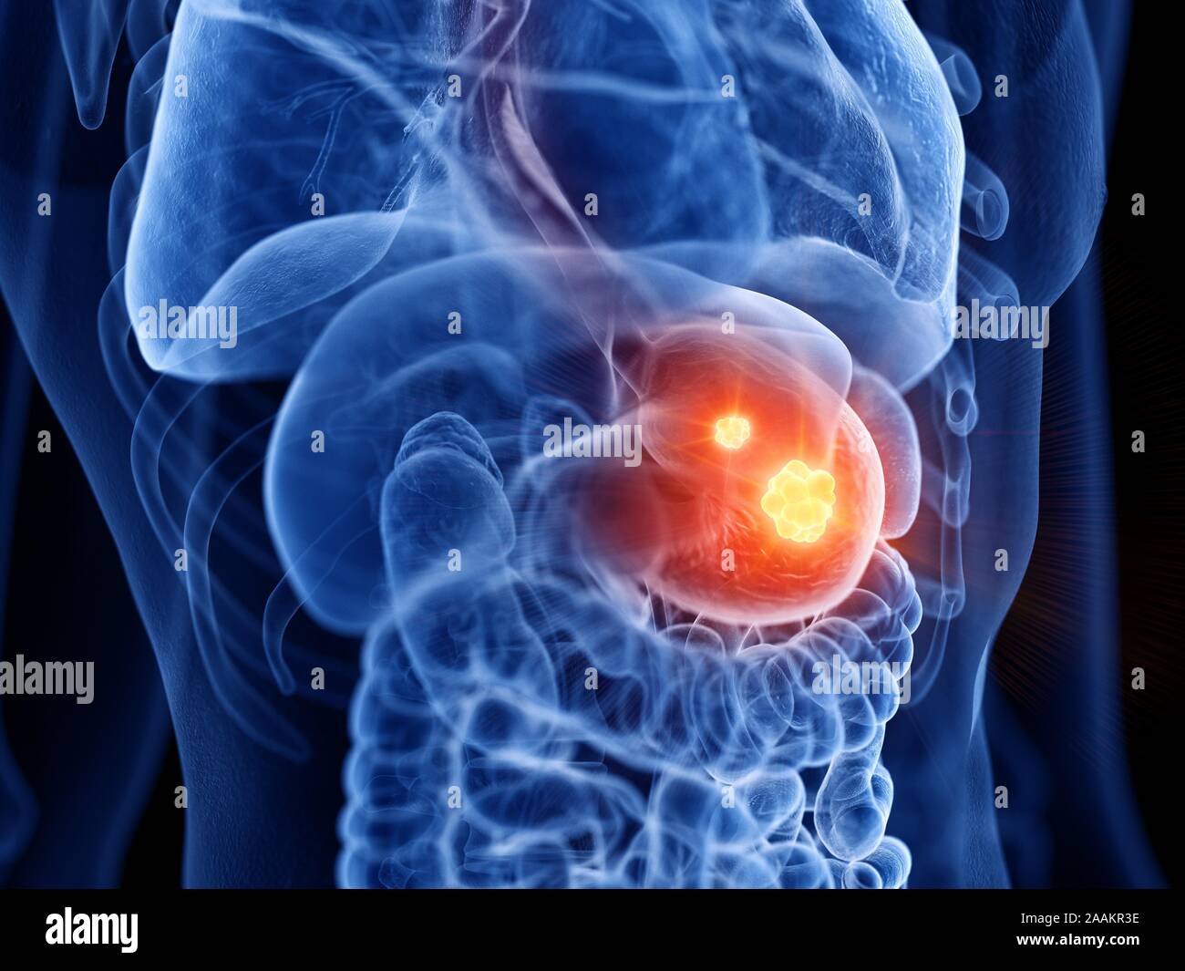 Magenkrebs, computer Abbildung. Stockfoto