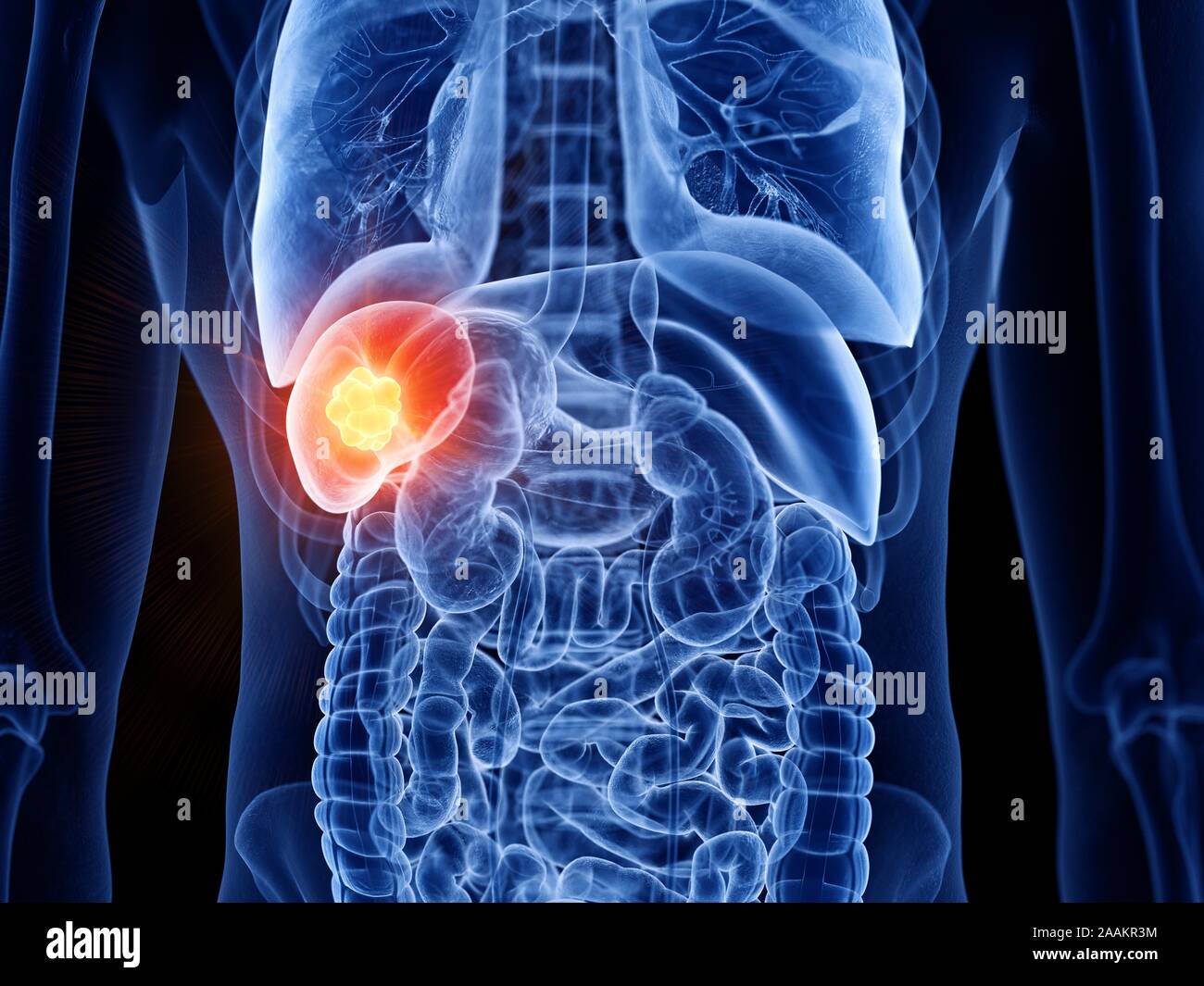 Milz Krebs, computer Abbildung. Stockfoto