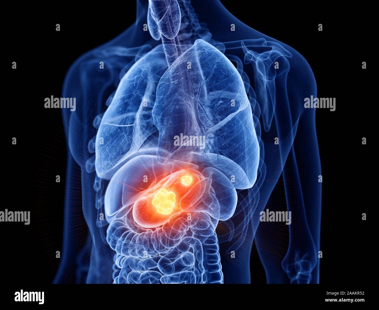 Magenkrebs, computer Abbildung. Stockfoto