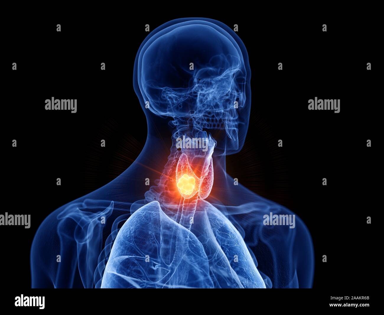 Schilddrüsenkrebs, computer Abbildung. Stockfoto