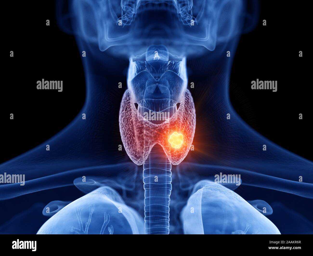 Schilddrüsenkrebs, computer Abbildung. Stockfoto