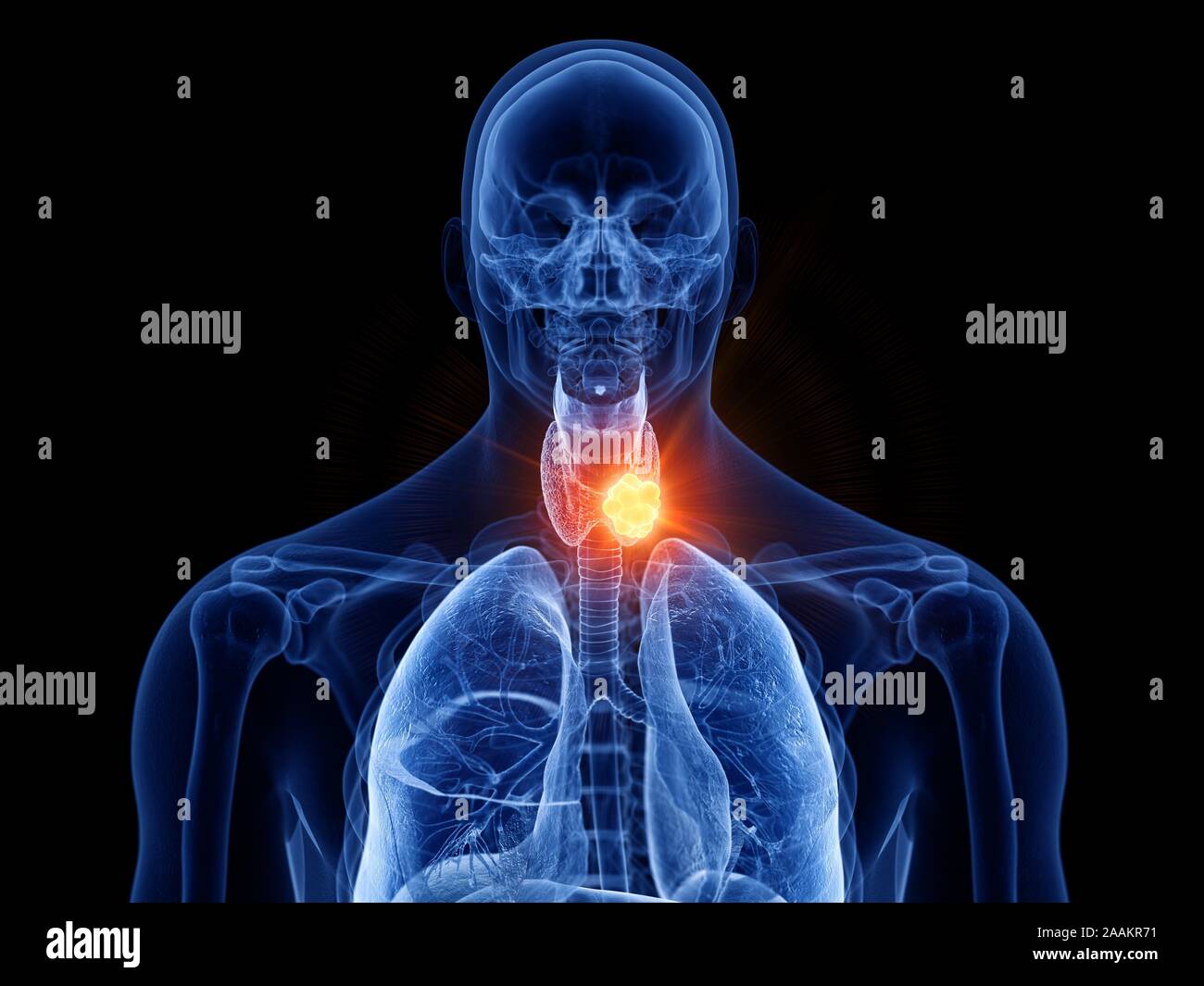 Schilddrüsenkrebs, computer Abbildung. Stockfoto