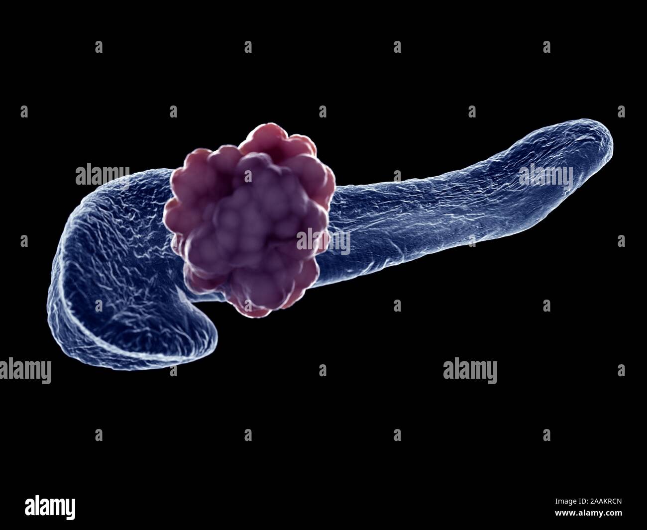 Pankreas Tumor, computer Abbildung. Stockfoto