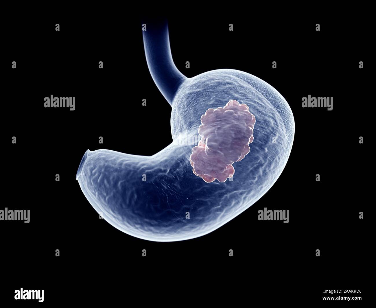 Magen Tumor, computer Abbildung. Stockfoto