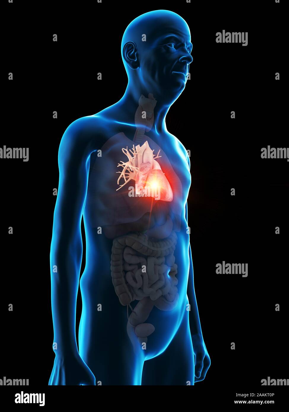 Abbildung: Herz Tumor eines alten Mannes. Stockfoto