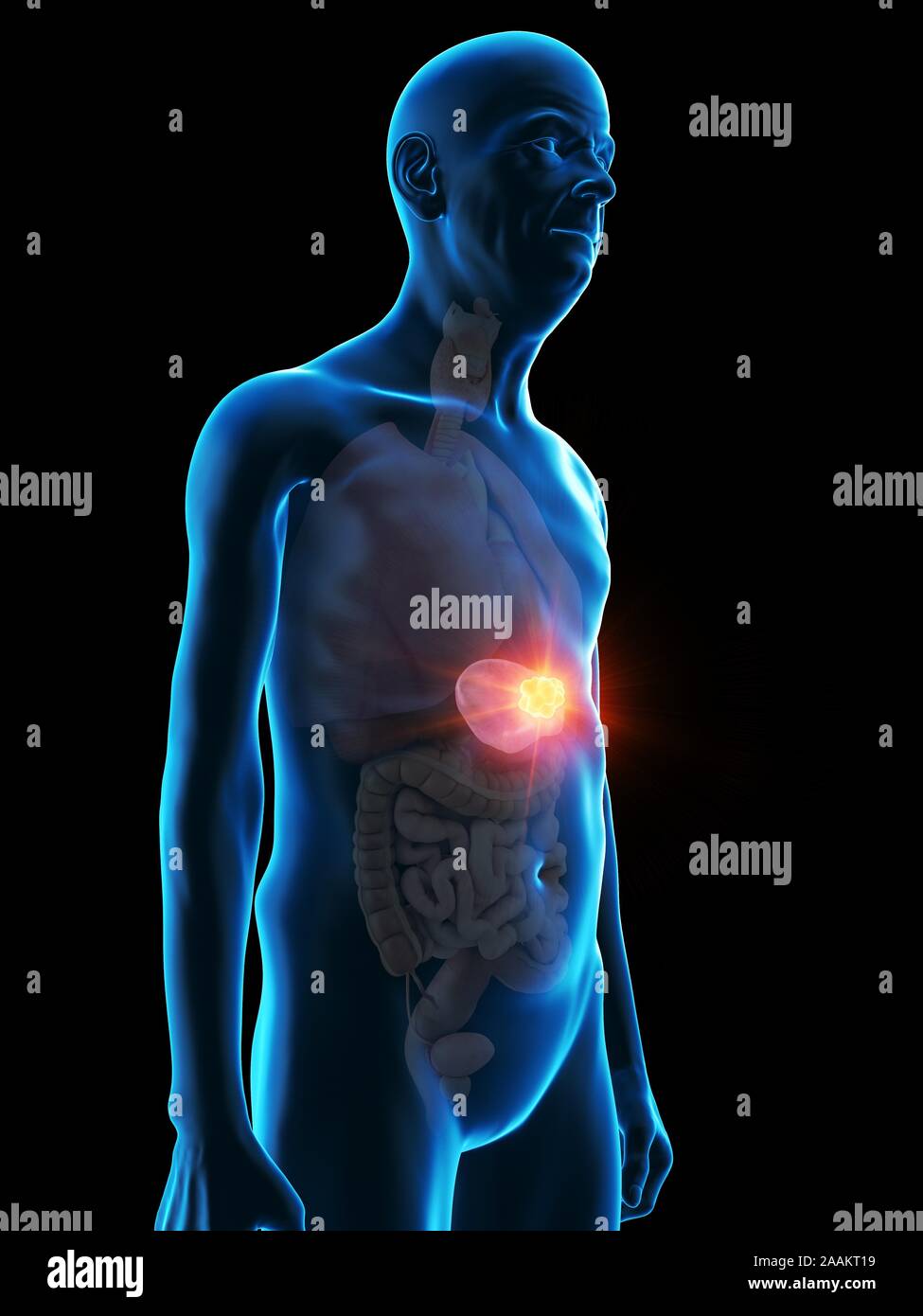 Abbildung: Milz Tumor eines alten Mannes. Stockfoto