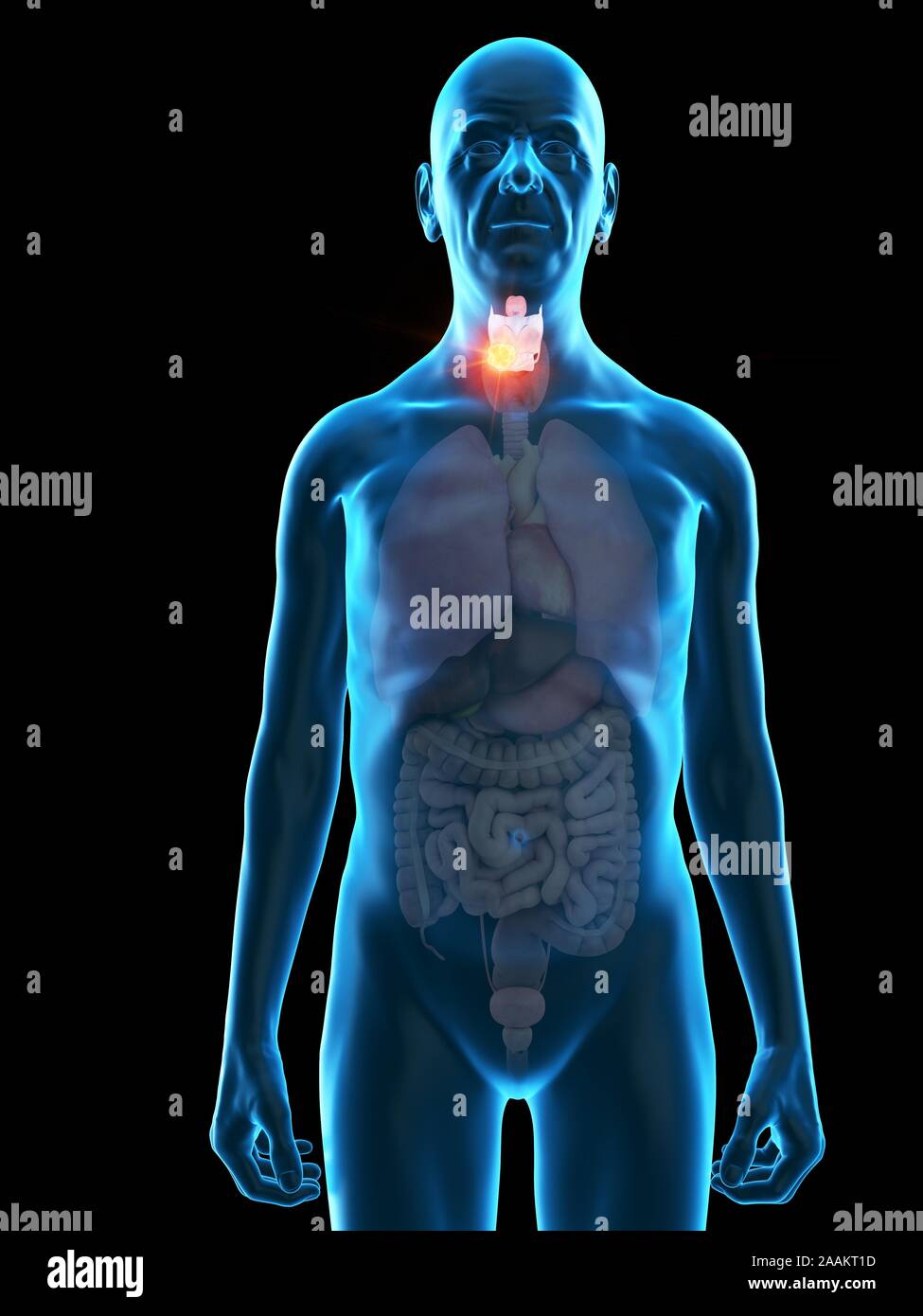 Abbildung: kehlkopf Tumor eines alten Mannes. Stockfoto
