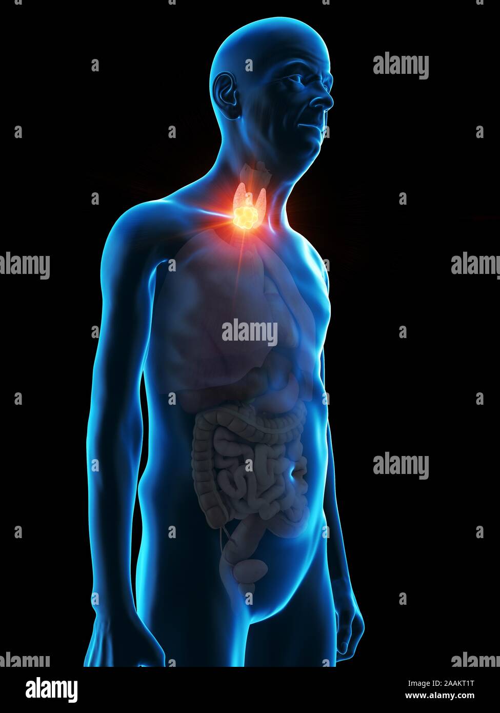 Abbildung: Schilddrüse Tumor eines alten Mannes. Stockfoto