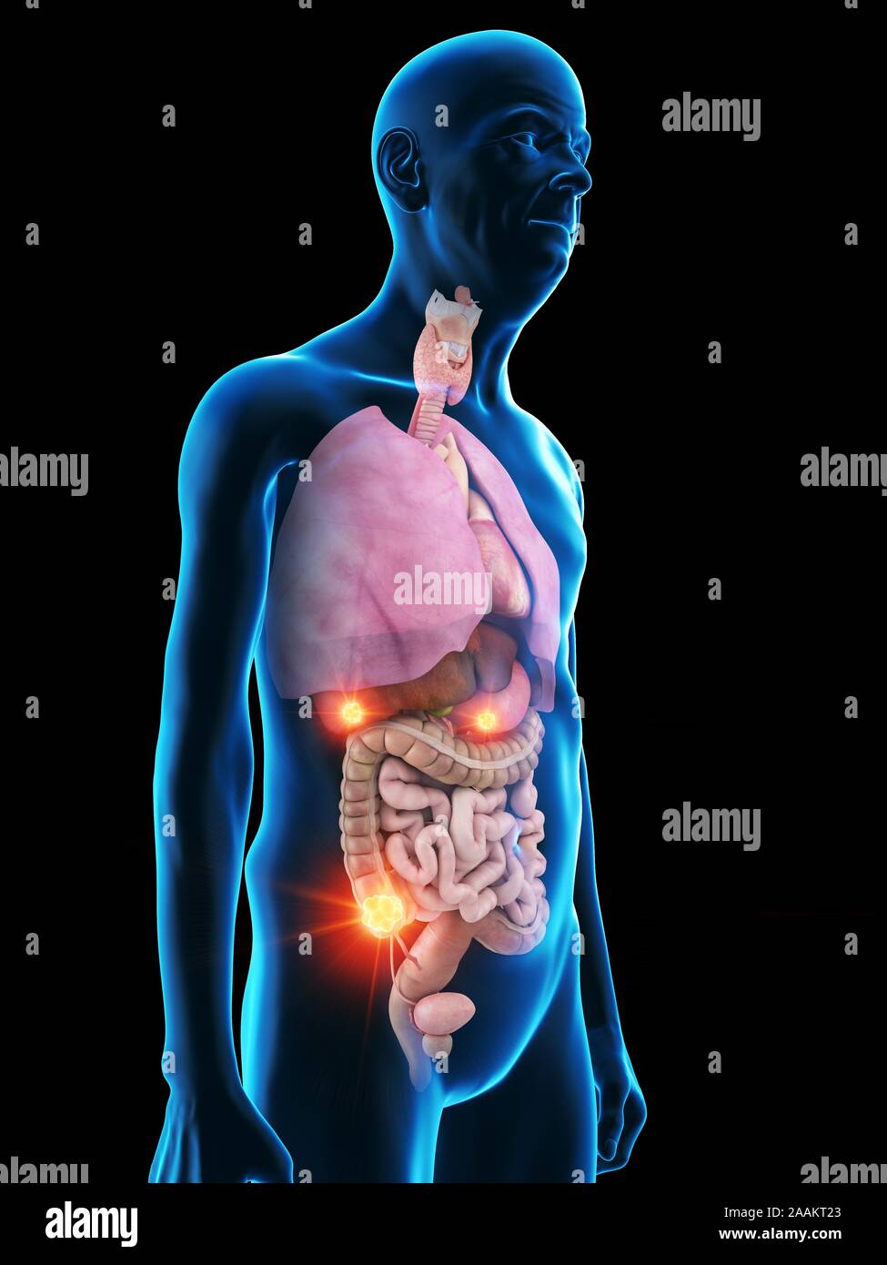 Alte Menschen mit Tumoren, computer Abbildung. Stockfoto