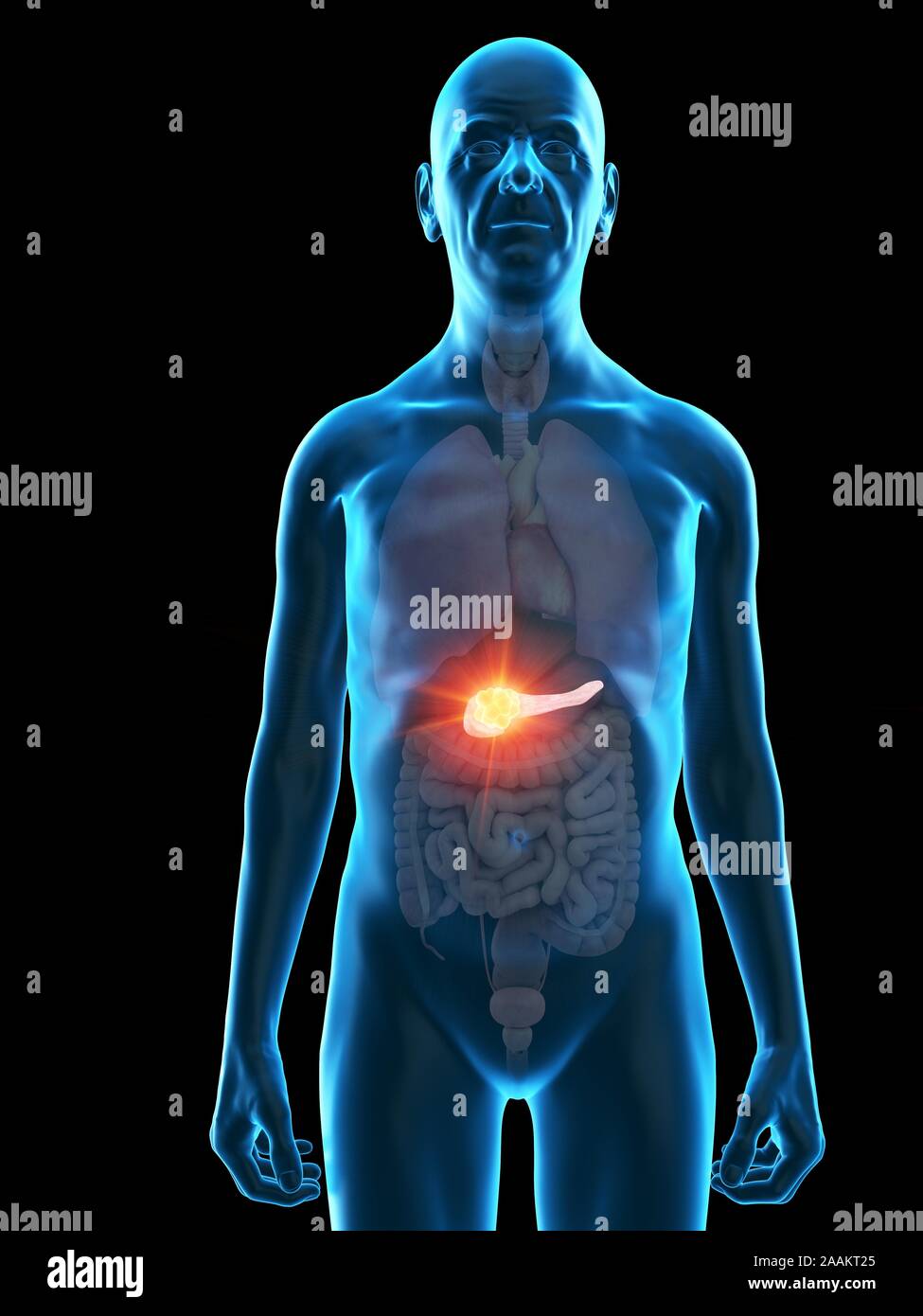 Abbildung: bauchspeicheldrüse Tumor eines alten Mannes. Stockfoto