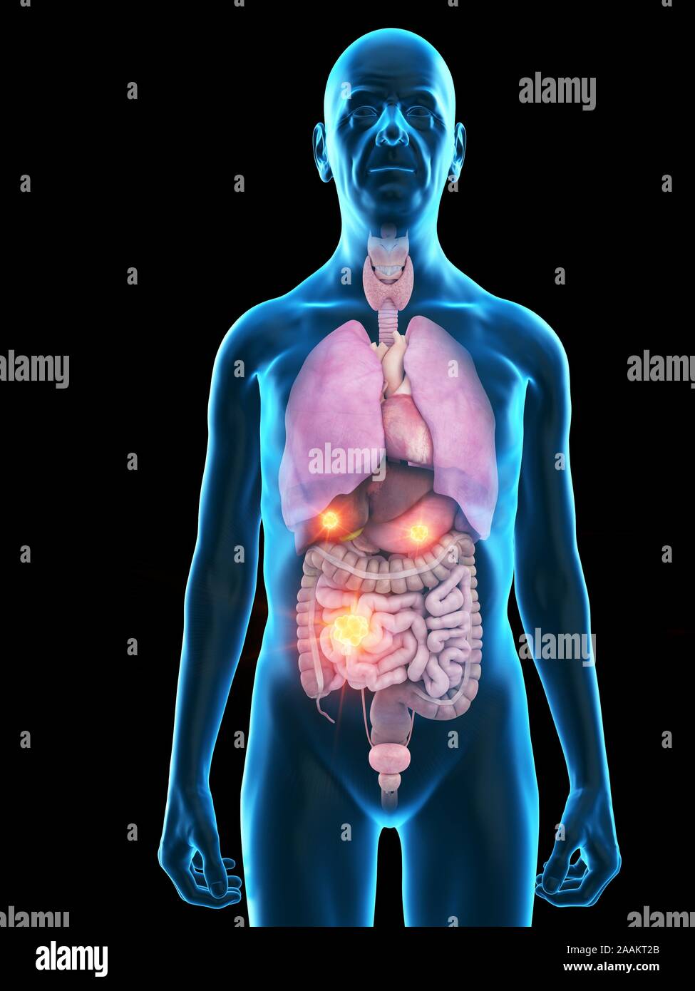 Alte Menschen mit Tumoren, computer Abbildung. Stockfoto