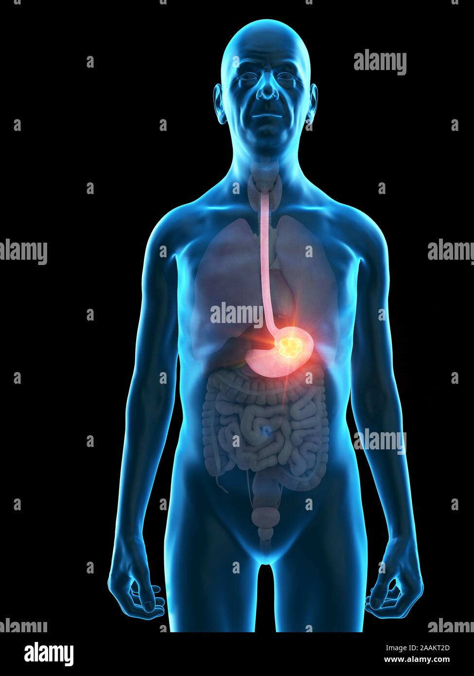 Abbildung: Magen Tumor eines alten Mannes. Stockfoto