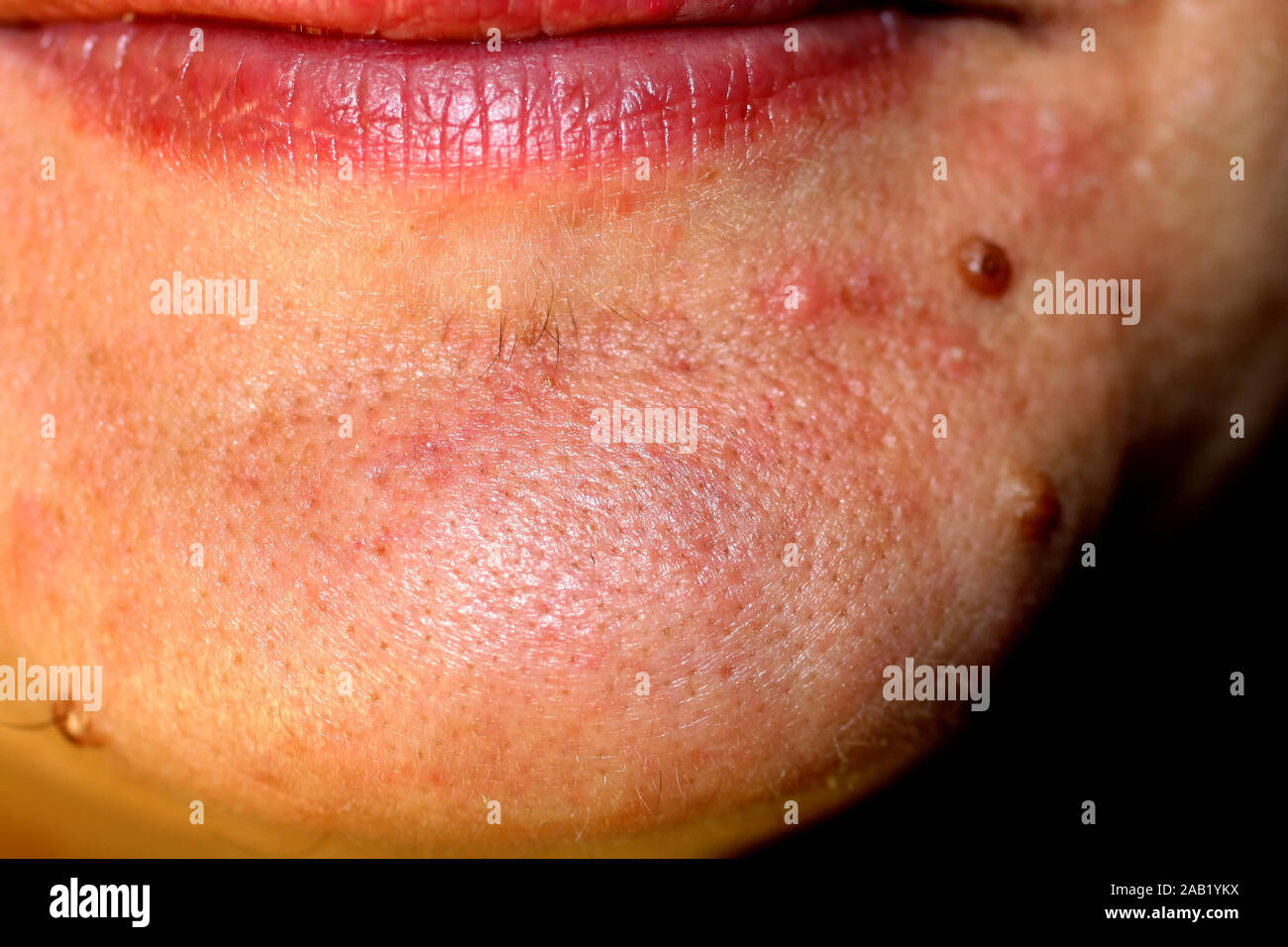 Muttermal auf sein Kinn. Eine Mole auf der Haut in Gesicht. Stockfoto