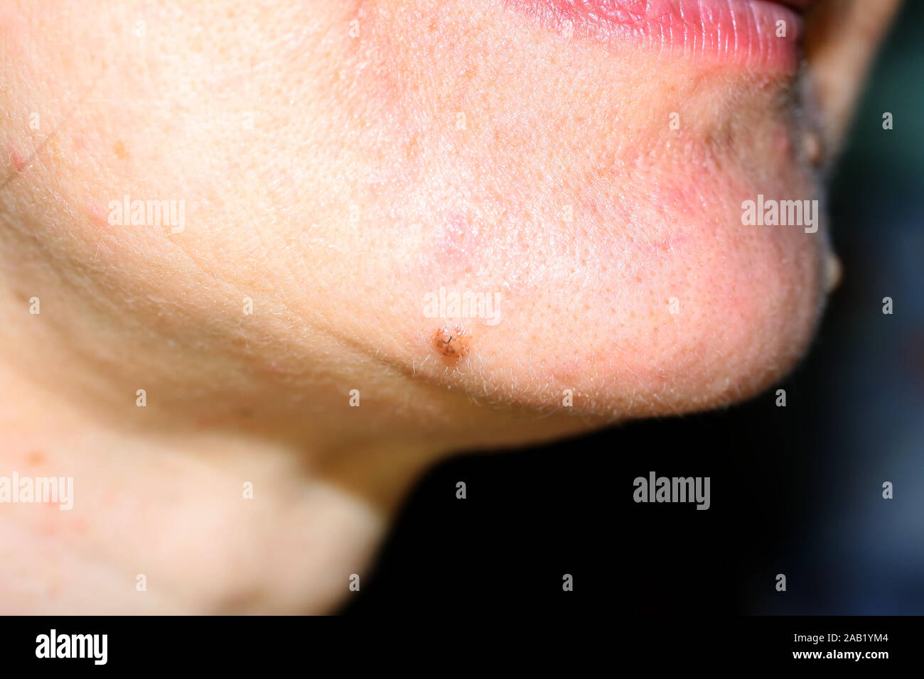 Beule Am Kinn Unter Der Haut www.alamy.de