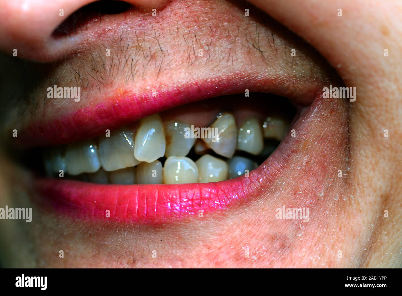 Schiefe Zahne Stockfotos Und Bilder Kaufen Alamy