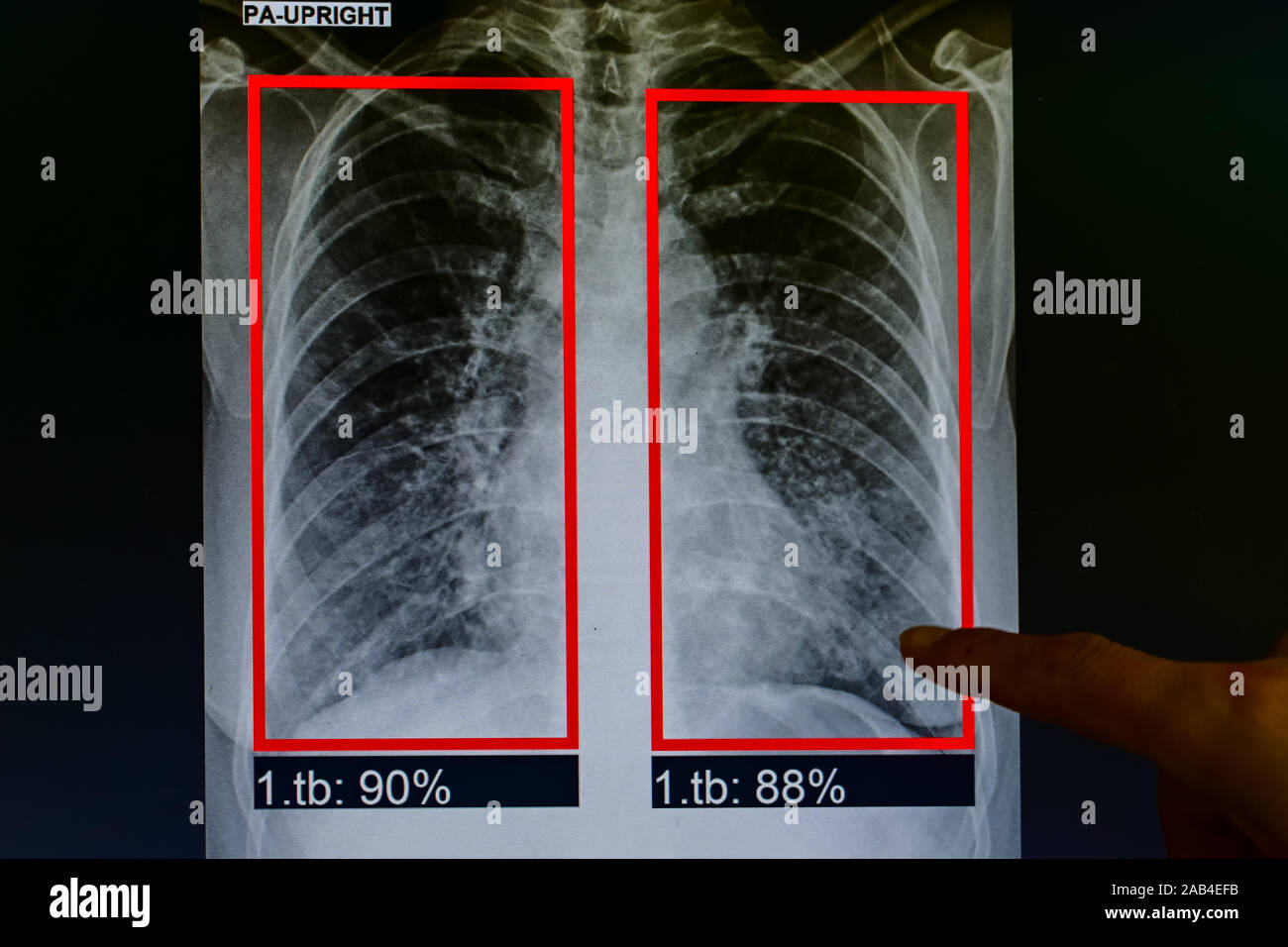 Arzt Hand wies mit dem Finger auf die Lunge flim des Patienten x-ray. hat mit Tuberkulose diagnostiziert wurde, die Diagnose Ergebnisse für die Patienten zu informieren. Stockfoto