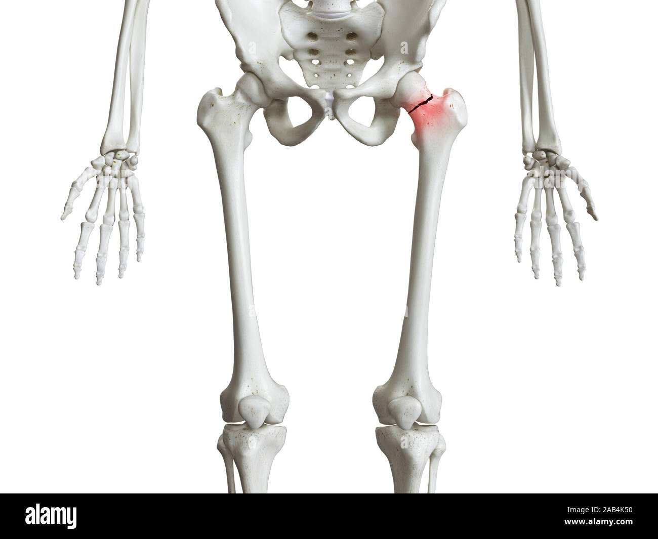 3D-gerenderte Medizinisch genaue Abbildung: Ein gebrochener Femur neck Stockfoto