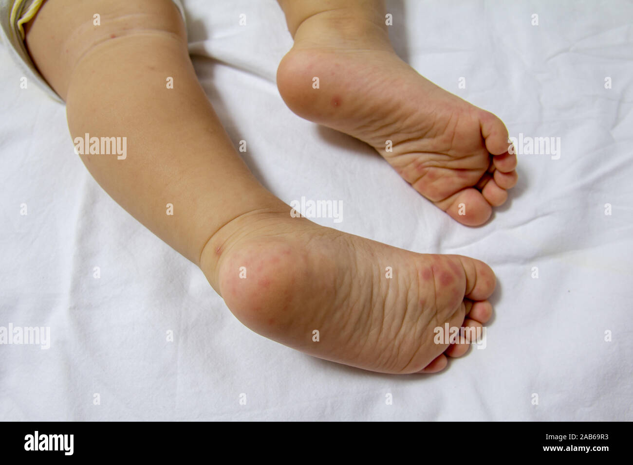 Hand fuß und mund Fotos und Bildmaterial in hoher Auflösung Alamy