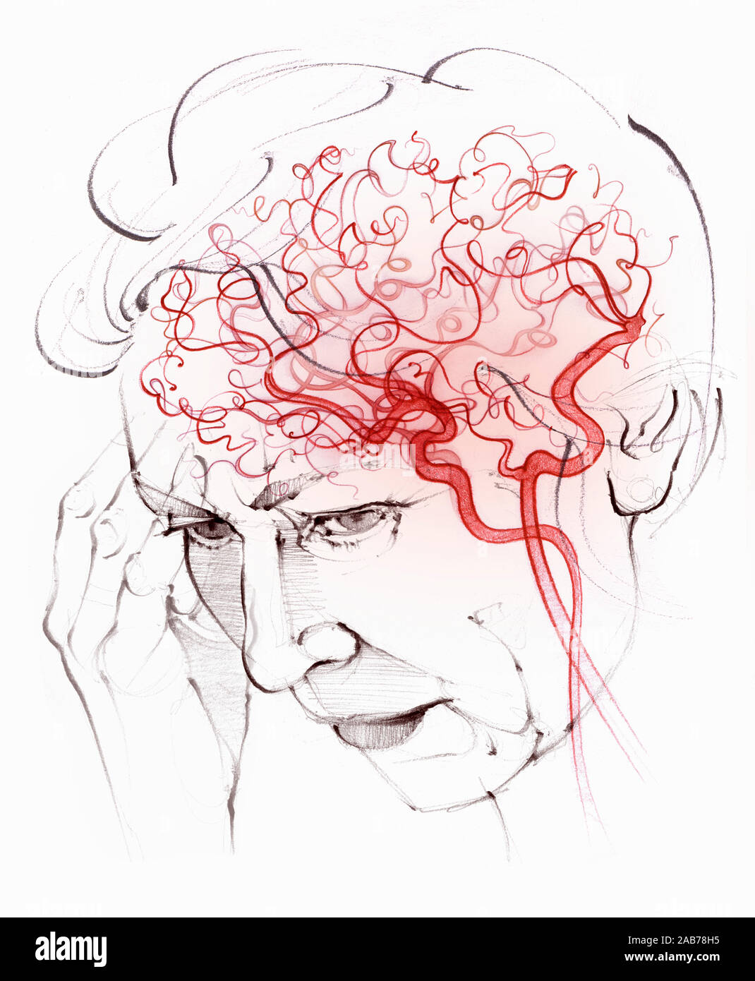 Gehirn Blutversorgung in ältere Frau mit vaskulärer Demenz Stockfoto