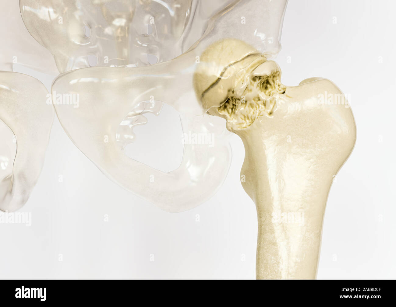 Schwere Arthrose der Hüfte - 3D-Rendering Stockfoto