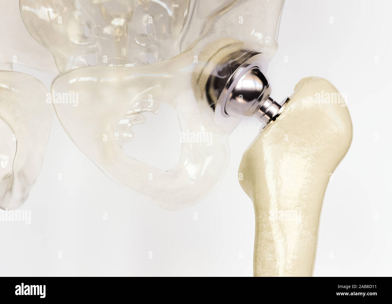 Künstliches Hüftgelenk nach schweren Arthrose - 3D-Rendering Stockfoto