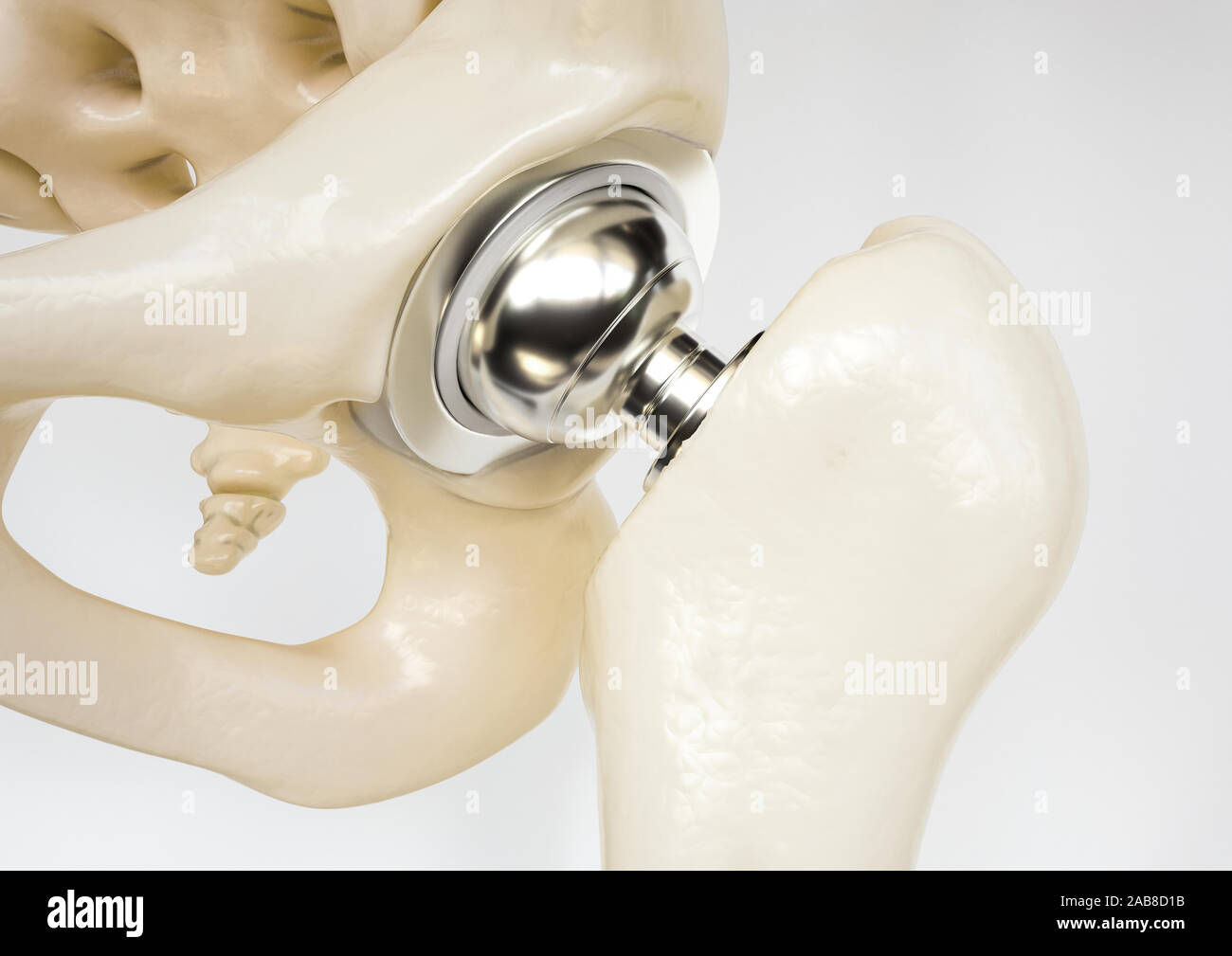 Künstliches Hüftgelenk nach Oberschenkelhalsbruch - 3D-Rendering Stockfoto