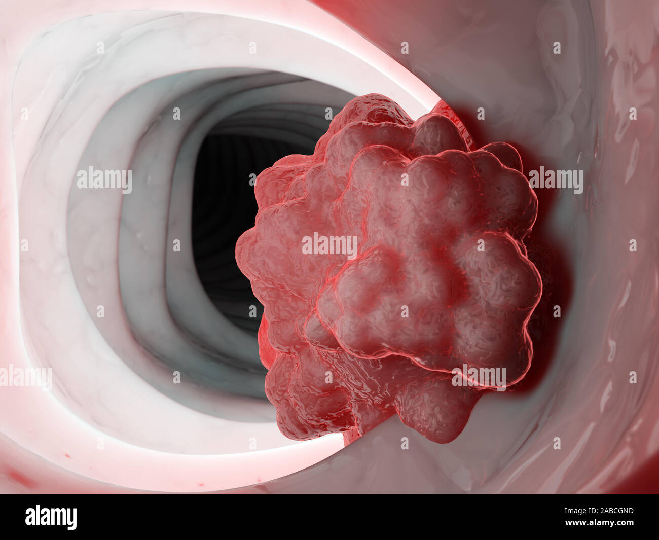 3D-gerenderte Medizinisch genaue Abbildung eines Tumors im Dickdarm Stockfoto