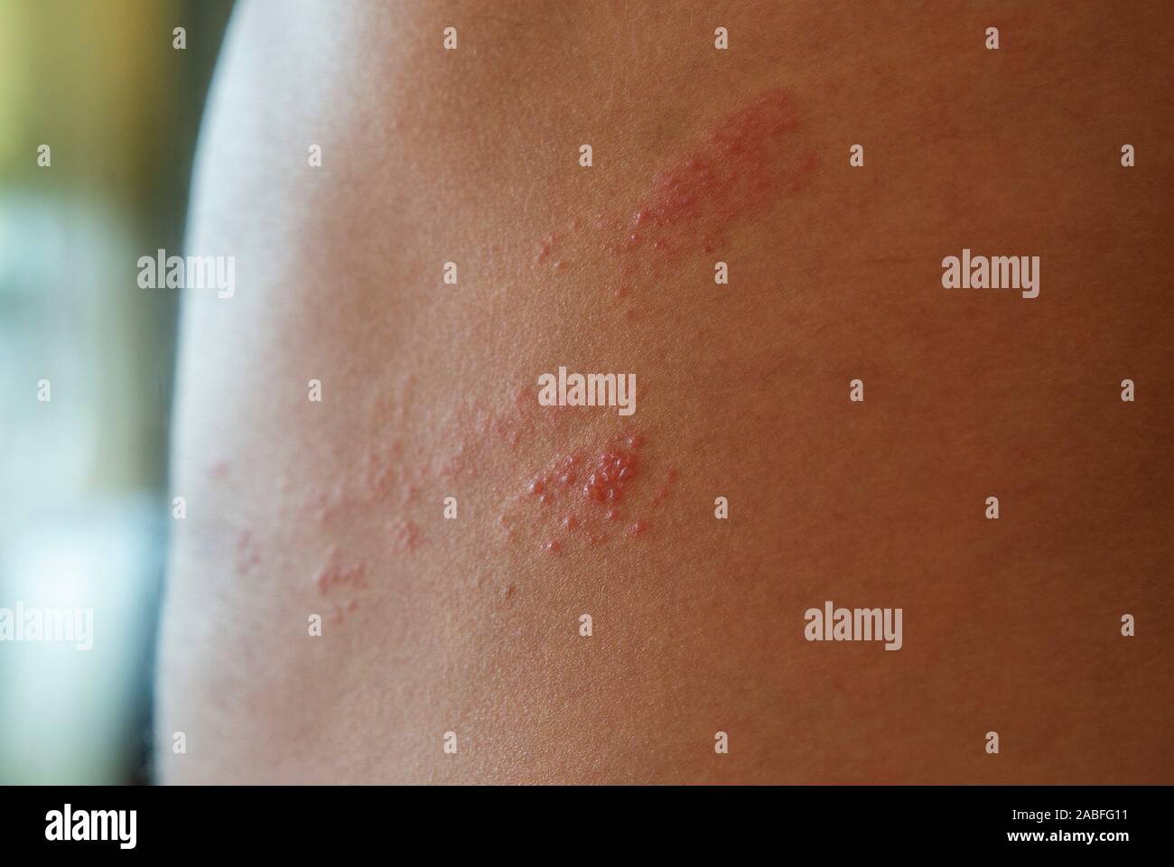 herpes auf der haut bilder