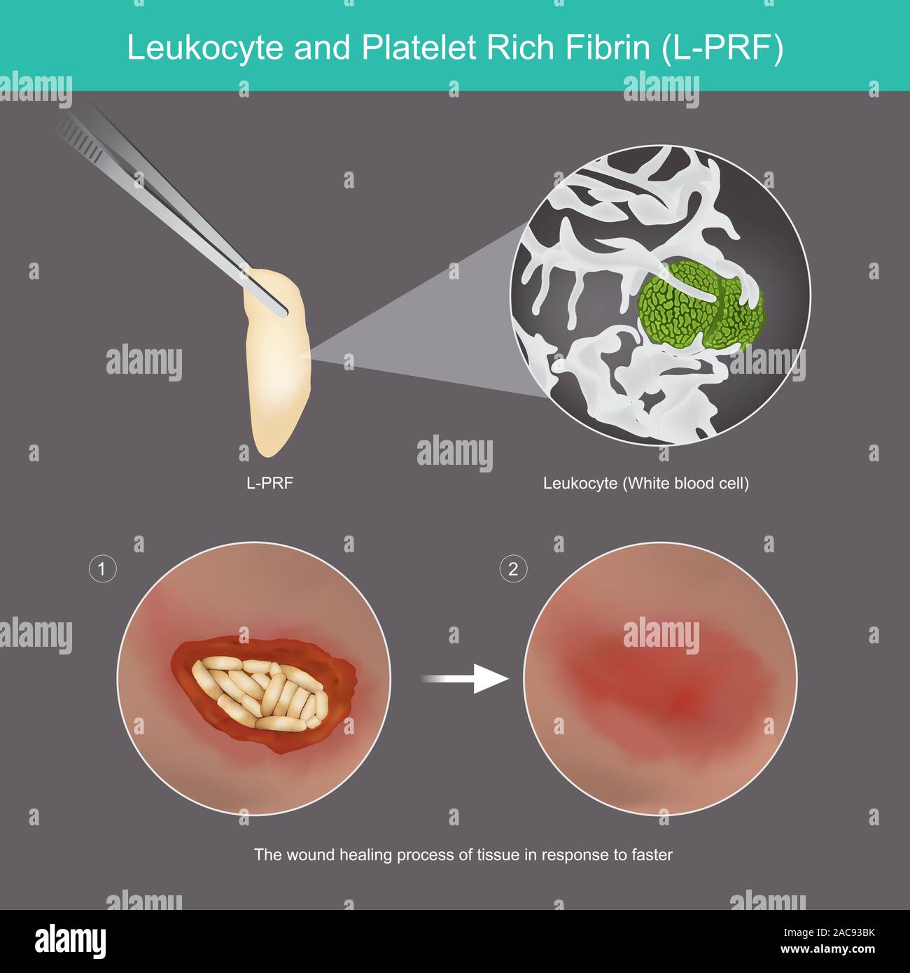 Leukozyten und Thrombozyten-reichen Fibrin. Abbildung: Wundheilung der Haut Gewebe, die durch die Nutzung von Leukozyten Thrombozyten-reichen Fibrin L-PRF. Stock Vektor