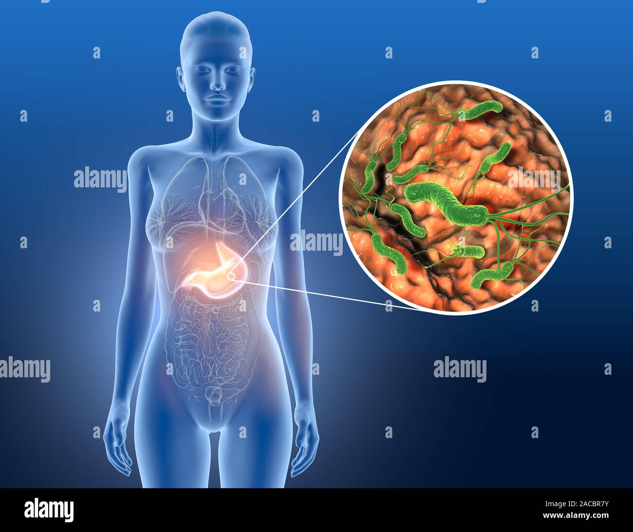 3D-Abbildung: Helicobacter pylori Bakterien schädlich Schleimschicht, Gastritis Stockfoto