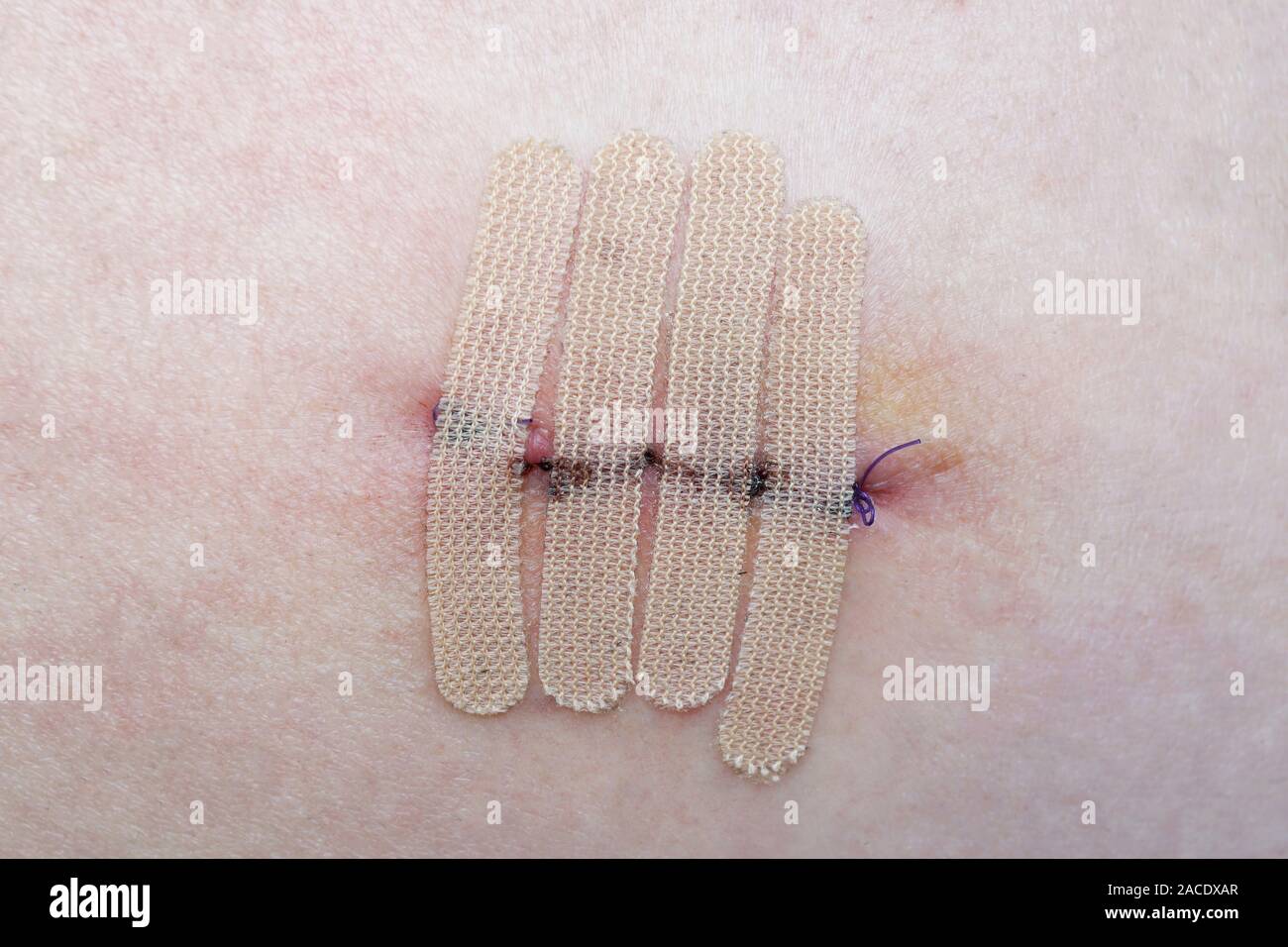 Nahaufnahme der menschlichen Haut mit Naht und den Wundverschluss Streifen oder chirurgischen Band nach Mole oder Melanom Biopsie Stockfoto