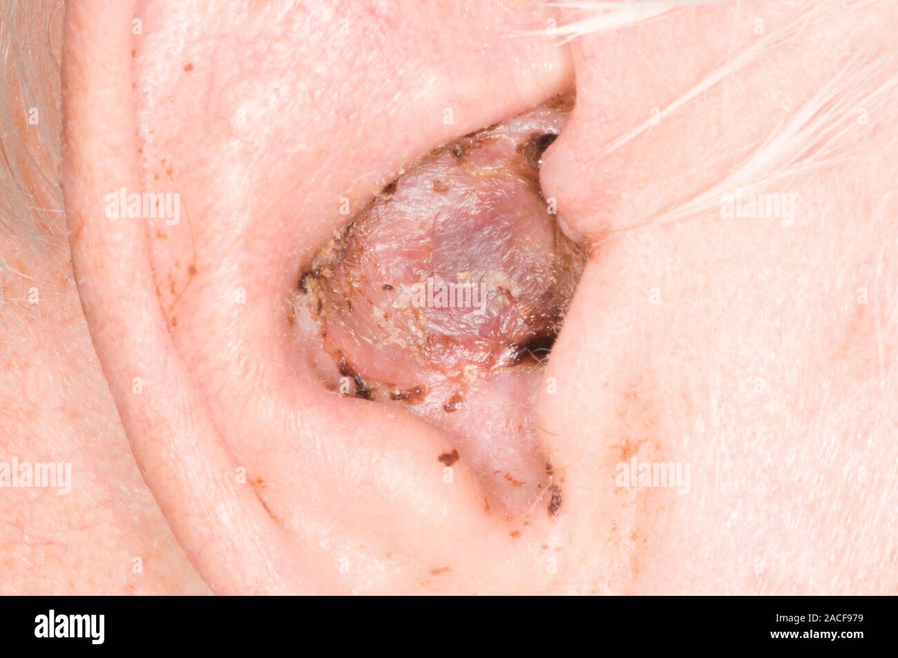 Hautkrebs Wunde am Ohr des Patienten. Wunde, die sich aus einer exzidiert  Plattenepithelkarzinom, eine Art von Krebs, der in spezialisierte  Epithelzellen entsteht Stockfotografie - Alamy