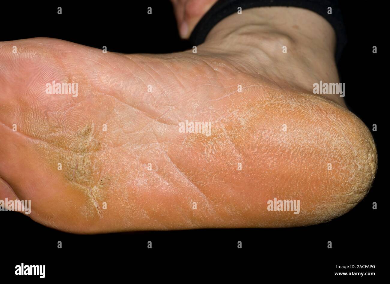 Fußpilz. Close-up des Patienten Fuß mit Fußpilz oder tinea Pedis, mit ...