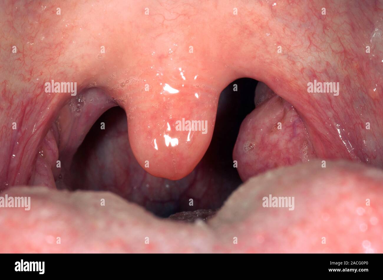 Asymmetrische gesunder Mandeln in den Mund. Die Mandeln werden Massen des lymphatischen Gewebes auf beiden Seiten der fleischige Zäpfchen (in der Mitte) und es ist eine normale v Stockfoto