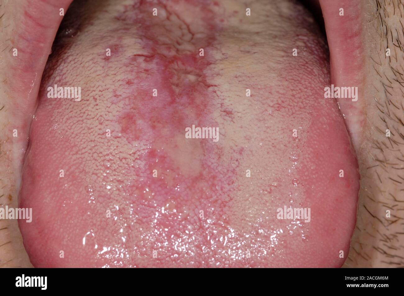 Nahaufnahme der Zunge der 27-jährige männliche Patient zeigen Thrush (Candida). Orale Candidose (Soor) Der Mund wird verursacht durch den Pilz Candida Stockfoto