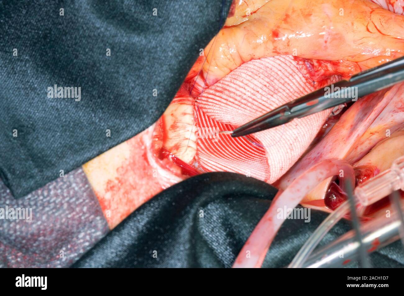 Operation am offenen Herzen. Chirurgen nähen ein Ersatz der Aorta. Diese Operation durchgeführt
