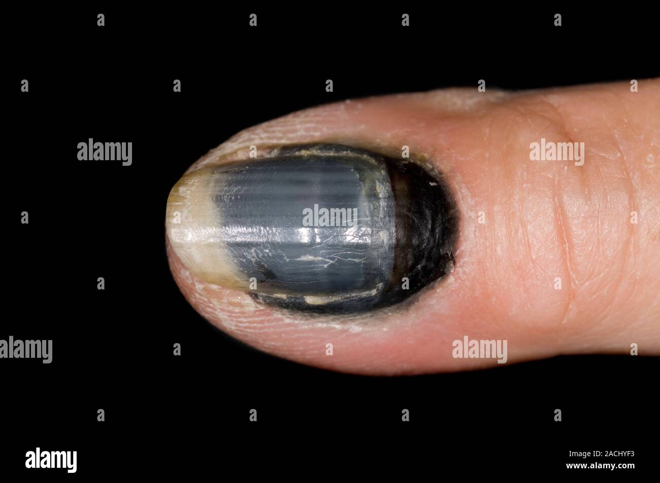 Verwunderlich Bluterguss Unter Dem Fingernagel Bilder