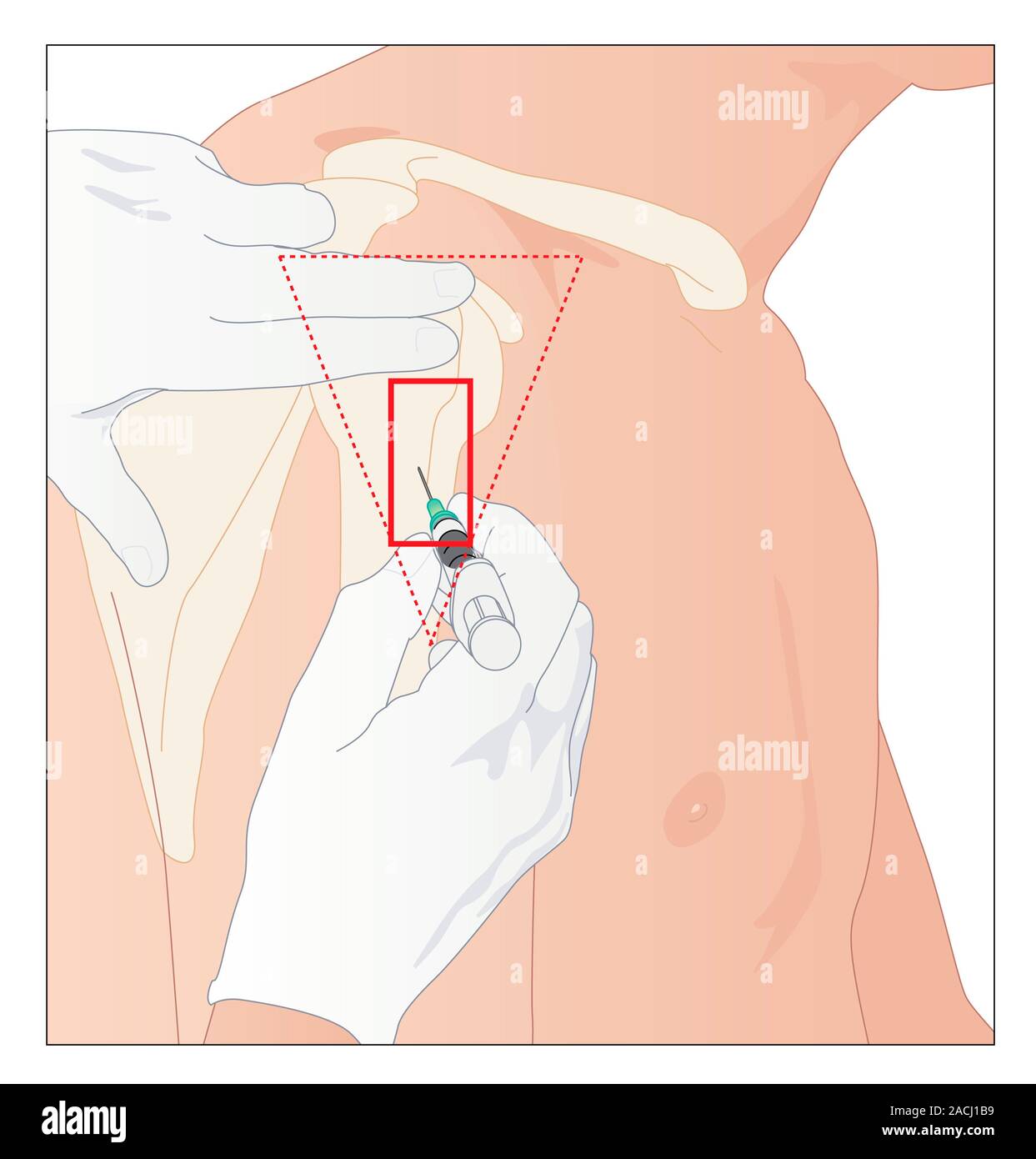Die intramuskuläre Injektion des Deltamuskels. Artwork zeigt die richtige  Site für einen Oberarm Injektion. In den Delta-muskel ist in den Oberarm.  Auf den Richtigen finden Stockfotografie - Alamy
