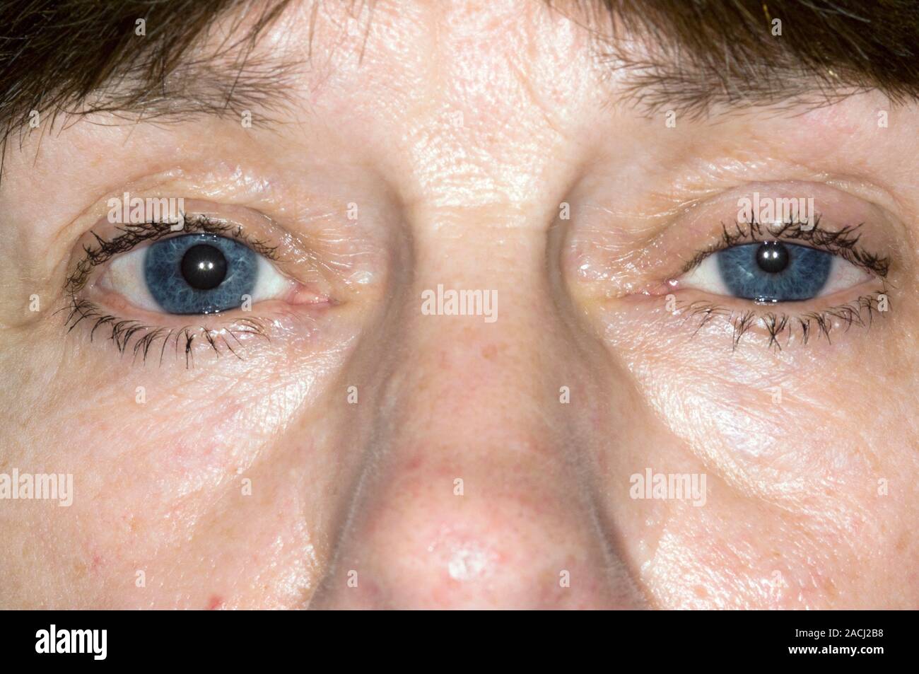 Hängenden Augenlid (Ptosis, linke Auge, rechts) und verengte Pupille des  Auges in eine 63 Jahre alte Patientin mit Horner-syndrom. Horner Syndrom  Stockfotografie - Alamy