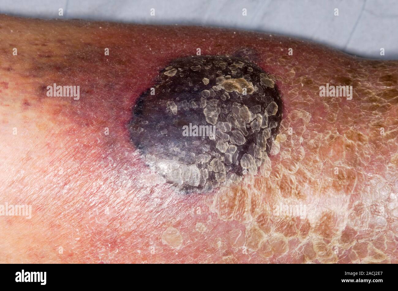 Bluterguss (Hämatom) auf der Shin in eine 81 Jahre alte Patientin nach einem stumpfen Trauma